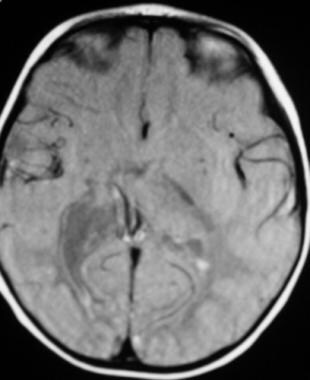 Periventricular Leukomalacia Imaging: Overview, Computed Tomography ...