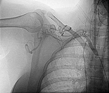 Thoracic outlet syndrome. An angiogram in a 35-yea