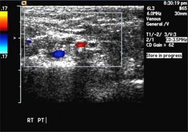 Bilateral popliteal vein thrombosis with normal co