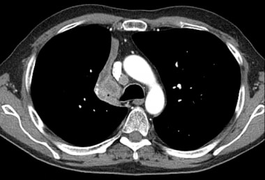 Atelectasis. CT scan of the chest shows tumor enca