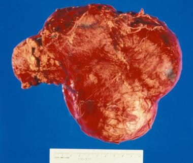 Gross nephrectomy specimen shows a Wilms tumor pus