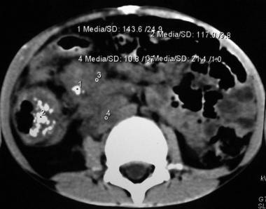 这张图片显示的是腹部7岁儿童的CT扫描