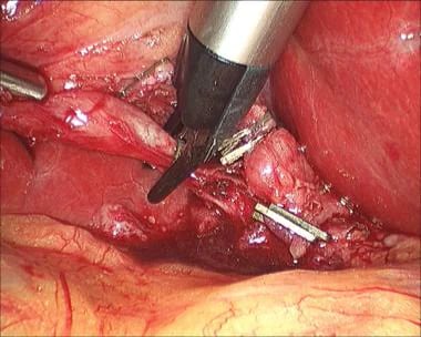 Laparoscopic cholecystectomy. Placement of clips o