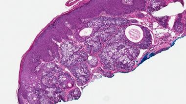 Sebaceous adenoma. Multilobulated and similar in o