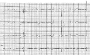This electrocardiogram illustrates third-degree at