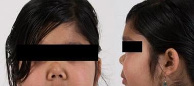 Patient with Wegener granulomatosis and saddle-nos