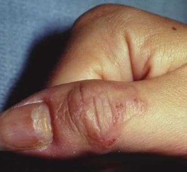 Cutaneous larva migrans on the right thumb. 
