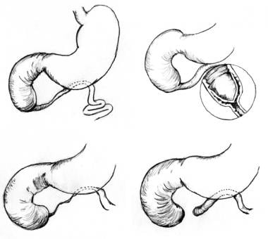 Pediatric duodenal atresia. Three anatomic types o