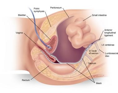 Enterocele and massive vaginal eversion.  Note the