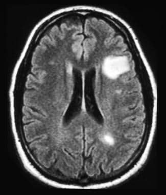 一例35岁复发性脑病患者头部MRI检查