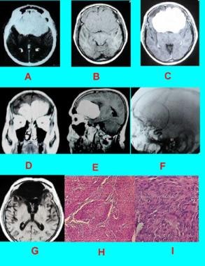 Case 6: Subfrontal meningioma in a patient with ab