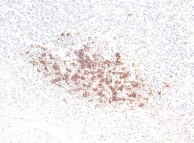Prion protein (PrP) accumulation in the tonsil in 