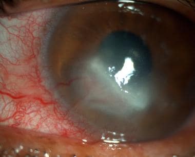 Fungal corneal ulcer, with excessive vascularizati