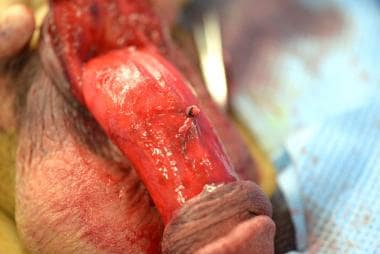 Ligation of the injured superficial dorsal vein up