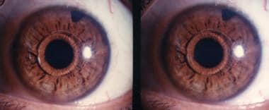 Phakic minus iris claw lens, 12 years postoperativ