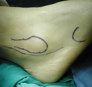 Lateral view of ankle, with marking of distal fibu
