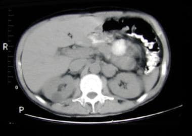 腹部计算机断层扫描(CT)