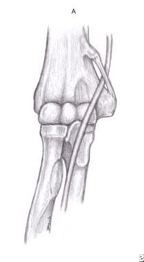 Ligament of Struthers. 