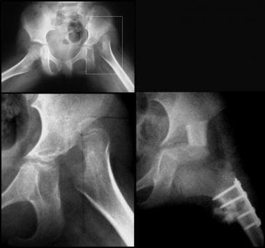 Radiographs from 6-year-old child who underwent op