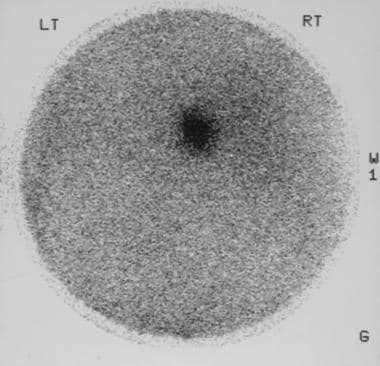 Scintigram obtained by using iodine-131-beta-iodom