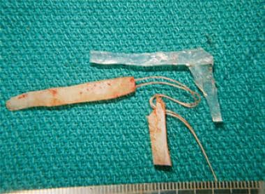 Silastic graft and rib bone graft. A 37-year-old w