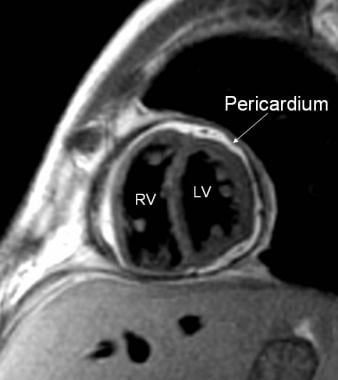 Constrictive Pericarditis. The magnetic resonance 