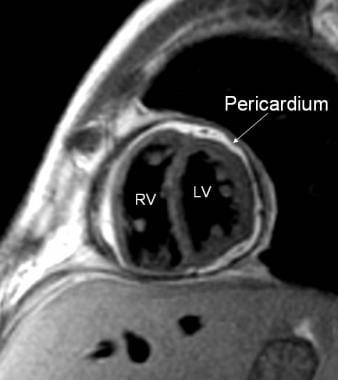 缩窄性心包炎。的核磁共振