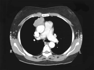 CT scan clearly illustrates mass in right anterola