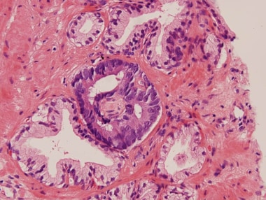 Prostate cancer. Adenocarcinoma around a small ner