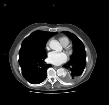 Patient showing a type B aortic dissection with ex