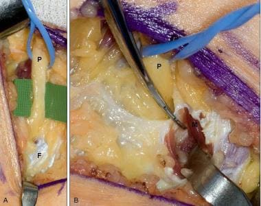 Common peroneal nerve decompression at the fibular