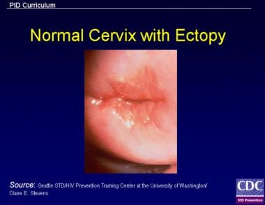 Cervical cellularity (ectopy), which is often pres
