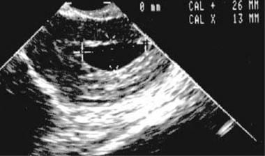 Second transvaginal sonogram obtained 1 week after