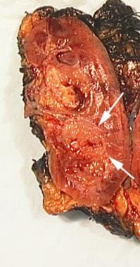 Pathology specimen shows urothelial tumor of renal