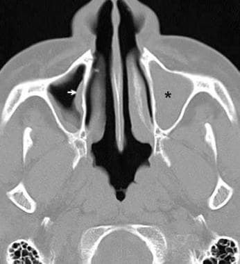CT scan of the sinuses demonstrates maxillary sinu