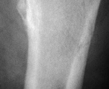 Enlarged view of the fracture shown in the above i
