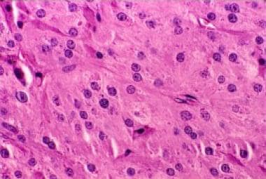 Leydig cell tumor. 