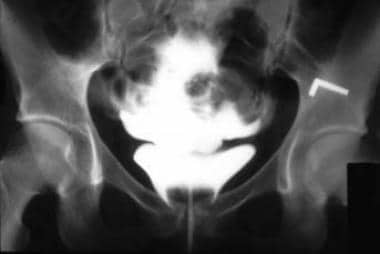 Cystogram of intraperitoneal bladder rupture. The 