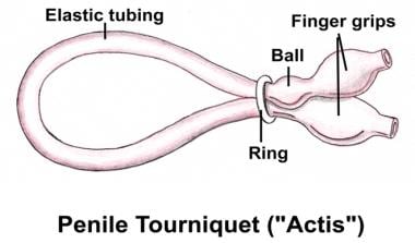 Erectile Dysfunction Treatment Management Approach