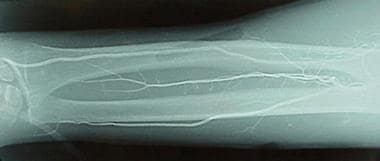 Forearm vessels in patient with distal embolizatio