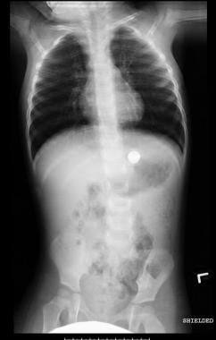 Disk battery in the stomach of an 18-month-old chi