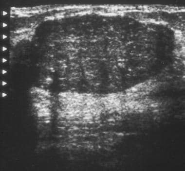 Ultrasonogram demonstrates a hypoechoic mass with 