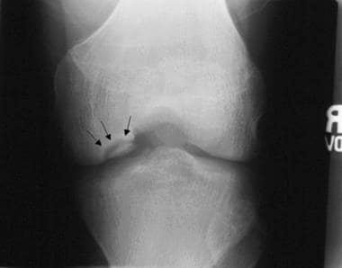 Anteroposterior radiograph of medial femoral condy