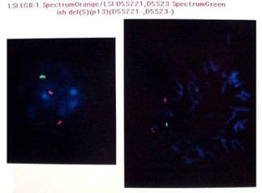Fluorescent in situ hybridization (FISH) study of 