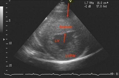 Echocardiogram, short-axis view in diastole, in th