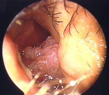 Anterior nasal papilloma arising from the septum. 