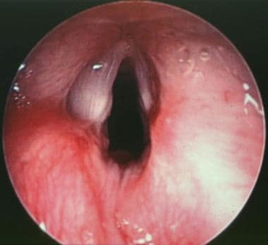 Postoperative close-up view of the true vocal cord