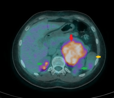 This axial fused 18F-FDG PET/CT image shows a larg