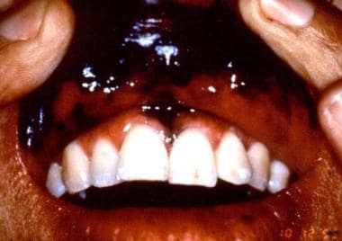 malignant melanoma mouth