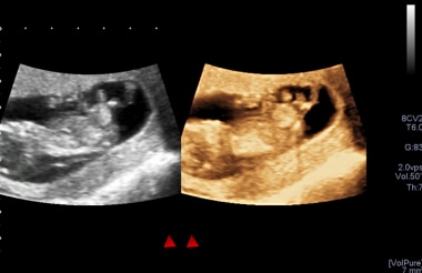 3D ultrasound shows an omphalocele in early pregna